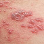 Penderita Diabetes dan Obesitas: Mengapa Rentan Terkena Infeksi Jamur di Kulit?