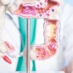 Mengungkap Penyebab Kanker Usus Besar: Bisa Dicegah dengan Langkah Tepat